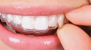 ortodoncia invisalign